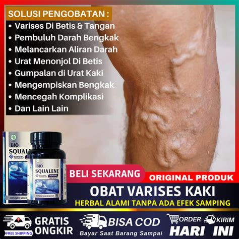 Obat Varises Kaki Obat Varises Di Betis Kaki Obat Penghilang Parises