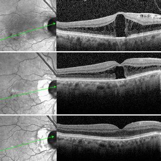 Sd Oct Scans Of Patient Top Preoperative Sd Oct Shows Outer