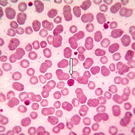 Peripheral Blood Smear Shows Large Platelet Arrow In A Case Of