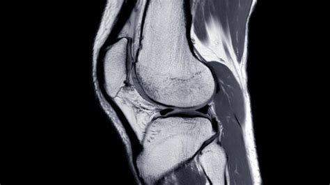 Chondromalacia Patella | Chondrosis of the Knee