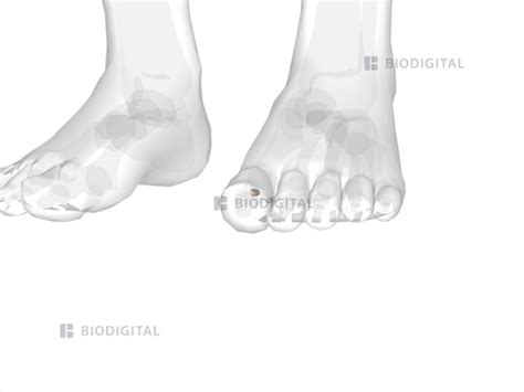 Sesamoid bones of left foot | BioDigital Anatomy