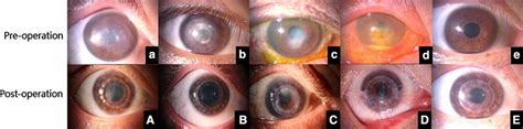 Outcome Of Five Recipients Using Fungi Positive Donor Corneas The