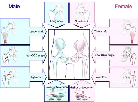 Sex Differences In Hip Morphology Is Stem Modularity Effect JBJS