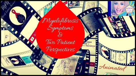 Myelofibrosis Symptoms & Two Patient Perspectives MPN - YouTube