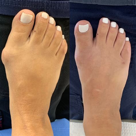 Before And After Bunion Surgery Photos The Bunion Cure