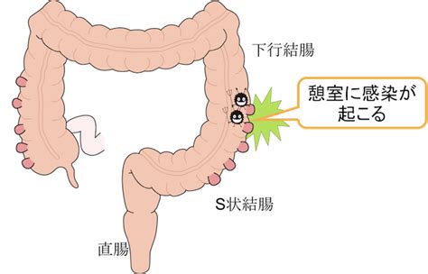 【図解】女性の左下腹部の痛みがある時に原因として考えられる病気は？