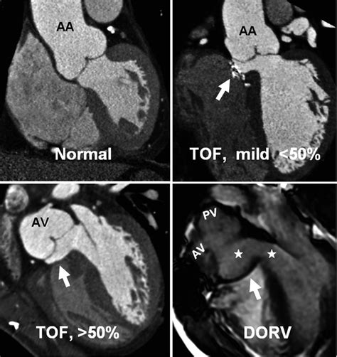 Right Ventricle Outflow Tract | Radiology Key