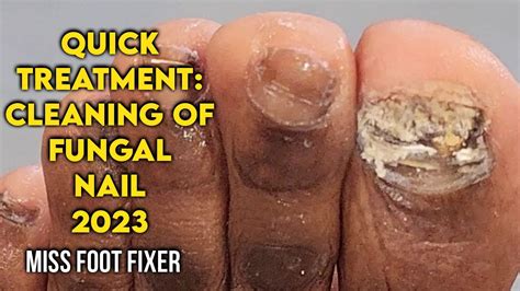 QUICK TREATMENT CLEANING OF A FUNGAL NAIL IIN 7 MINUTES BY FOOT