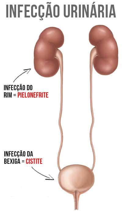 Qual O Risco Da Infecção Urinária Na Gravidez Fetalmed