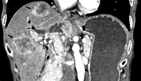 Contrast Enhanced Computed Tomography Ct Scan Showed Hepatic Download Scientific Diagram