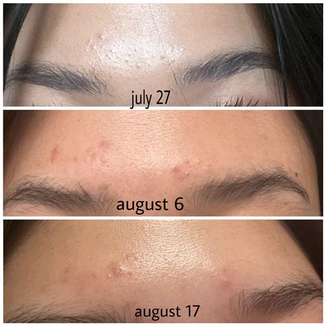 [routine Help] Yearly Comedones That Turn Into Stubborn Acne And Then Go Away R Skincareaddiction