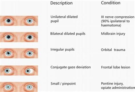 pupils sizes emcage