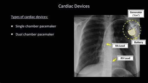 How To Interpret A Chest X Ray Lesson 9 Atelectasis Lines Tubes De