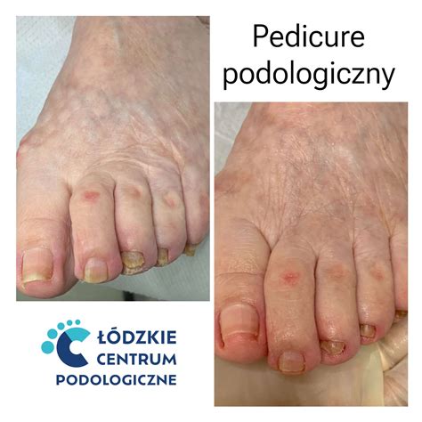 Pedicure leczniczy Łódzkie Centrum Podologiczne