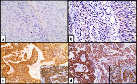 EGFR Immunohistochemical Expression In Urothelial Carcinoma UCa A