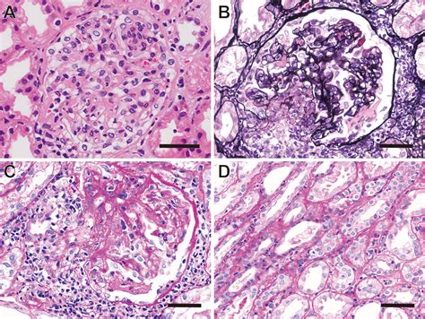 Figure 2 From Anti Neutrophil Cytoplasmic Antibody Associated