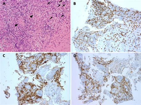 Microscopic findings of germinoma. A Section shows scattered aggregates ...