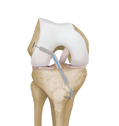 Internal Brace In Depth The Knee Mackay Clinic