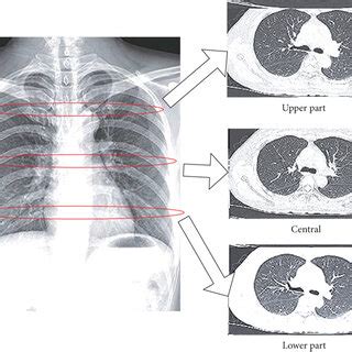 Spiral CT image of lung cancer. | Download Scientific Diagram