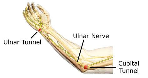 Ulnar Nerve Entrapment Cubital Tunnel