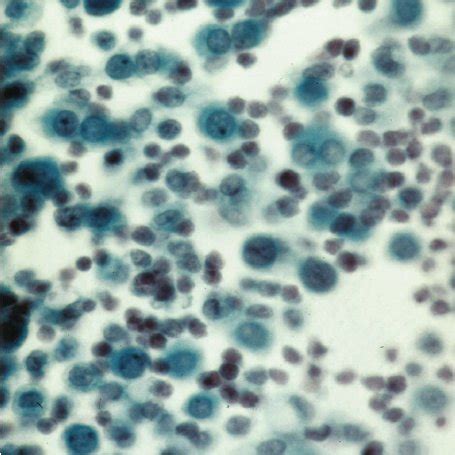 A cytology slide demonstrating numerous mesothelial cells in the ...