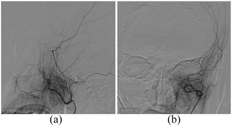 Selected Angiographic Images A Digital Subtraction Angiography Dsa