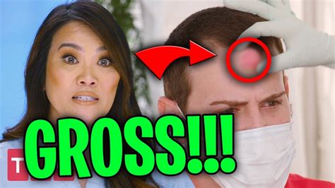 The Grossest And Most Disgusting Moments From Dr Pimple Popper Youtube