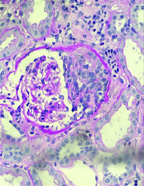 Case 1. Active nephritis shown on kidney biopsy. Native kidney biopsy ...