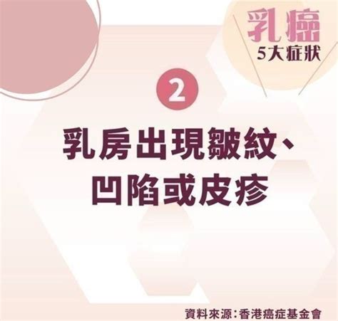 乳癌｜胸部痕癢出水半年 女子誤當濕疹搽藥膏求醫驚揭患乳癌