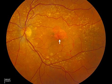 New Treatment For Macular Degeneration Dry Amd Treatment