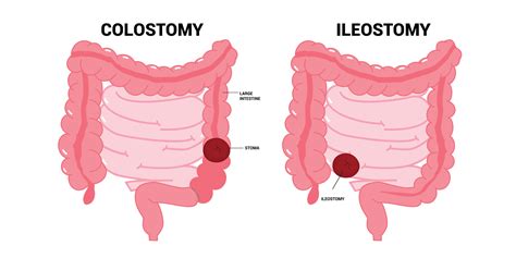 The Ileum Stoma Abdomen Pouch For Blocked Poo Stool System Of Small