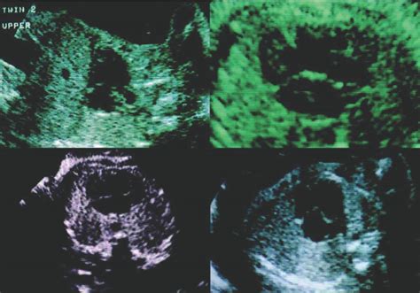 La Importancia De La Ecocardiografía Fetal En La Detección Y El Manejo