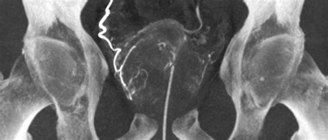 Prostatic Artery Embolization Department Of Radiological Sciences