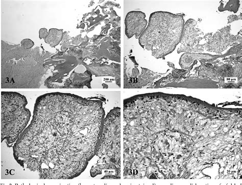 Figure 3 From INTRAOSSEOUS PROLIFERATIVE SPARGANOSIS PRESENTING AS A