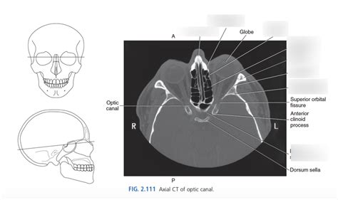 Axial CT of Optic Canal Diagram | Quizlet