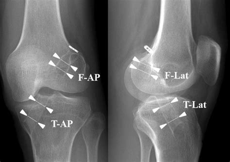 Postoperative Anteroposterior Ap And Lateral Radiographs Showing