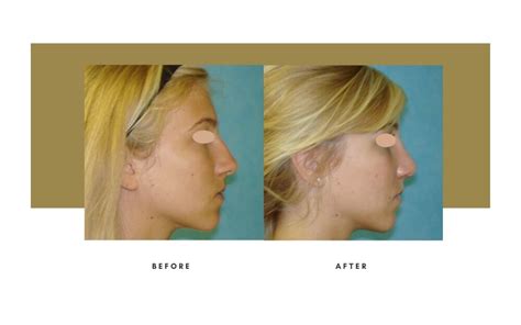 Rhinoplasty Beverly Hills Nose Job Julie Edween D O