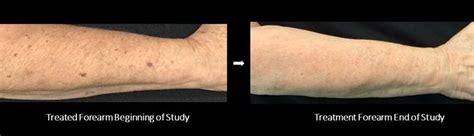 Dr. Siperstein Studies New Treatment for Forearm Bruising - Siperstein Dermatology Group