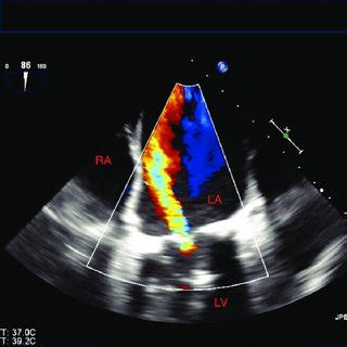 Site Of Transseptal Puncture Laa Left Atrial Appendage Pvi