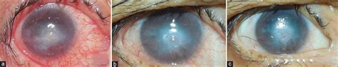 Insulin Eye Drops For Neurotrophic Keratitis Indian Journal Of Ophthalmology