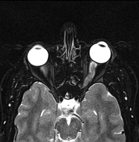 Optic Neuritis With Perineuritis Image