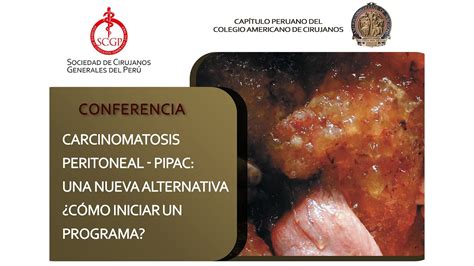 CARCINOMATOSIS PERITONEAL PIPAC UNA NUEVA ALTERNATIVA CÓMO INICIAR UN