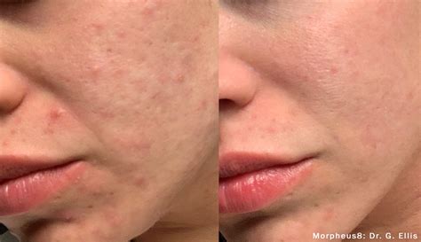 Morpheus8 Treatment Fractional Skin Remodeling New Health Kansas