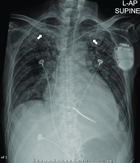 AP Supine Portable Chest Radiograph Reveals Diffuse Patchy