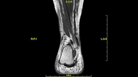 Peroneal Tendon Tear Treatment