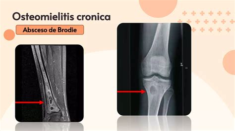 Osteomielitis Y Artritis Séptica Ppt