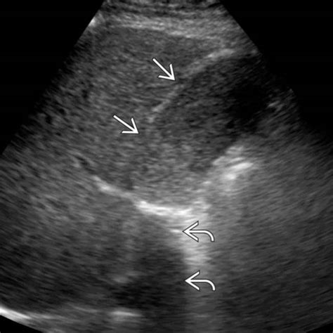 Milk Of Calcium Cyst Ultrasound