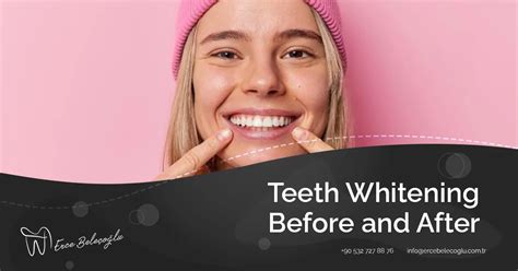 Teeth Whitening Before and After - Professional Teeth Whitening Before ...