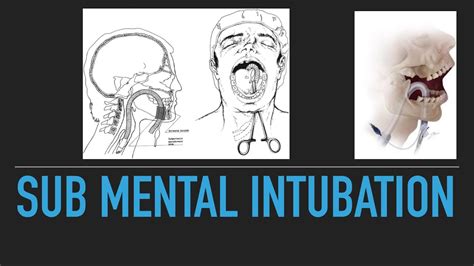 Sub Mental Intubation Youtube