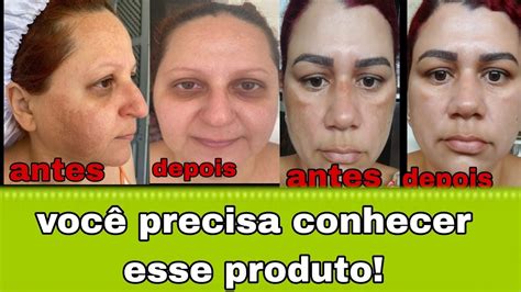 Saiba Como Clariar Melasma E Outras Manchas Escuras No Rosto Dermo